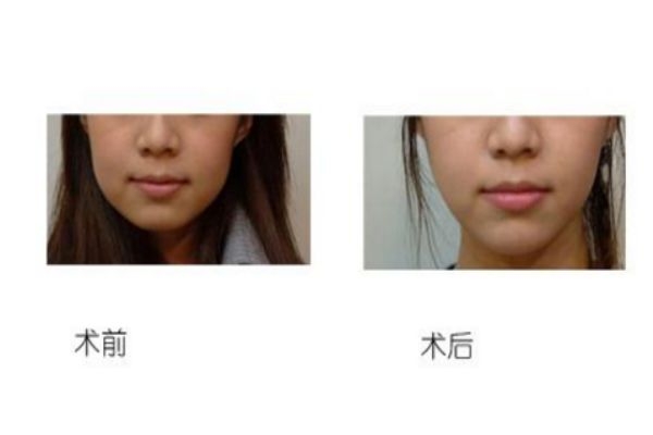 墊下巴前后對比照片 墊下巴的優(yōu)缺點(diǎn)