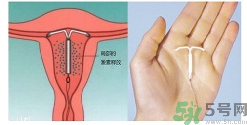 上環(huán)是什么意思？上環(huán)后注意事項有哪些？