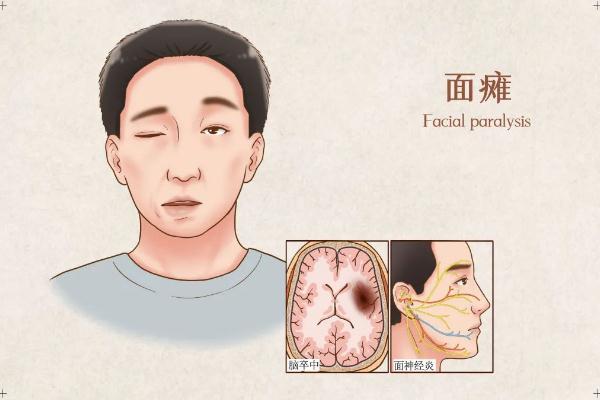 面癱針灸多久會好 面癱針灸治療最佳時(shí)間