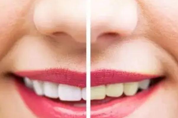 冷光美白牙齒會(huì)很白嗎 冷光美白牙齒對四環(huán)素牙有用嗎