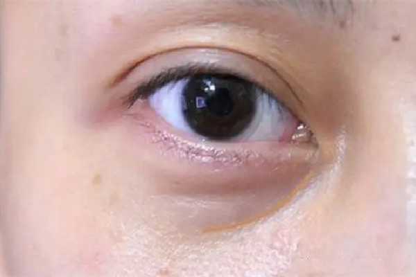 武漢淚溝填充哪家比較好 武漢哪家醫(yī)院淚溝修復(fù)好